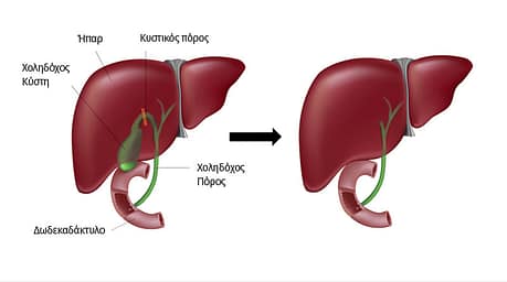 αφαιρεση χολης