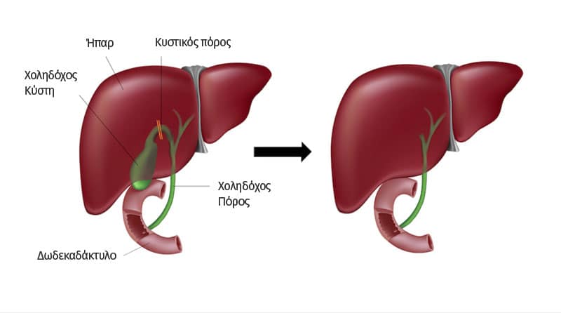 5 Διατροφικές Οδηγιές για την Αφαίρεση της Χοληδόχου Κύστης